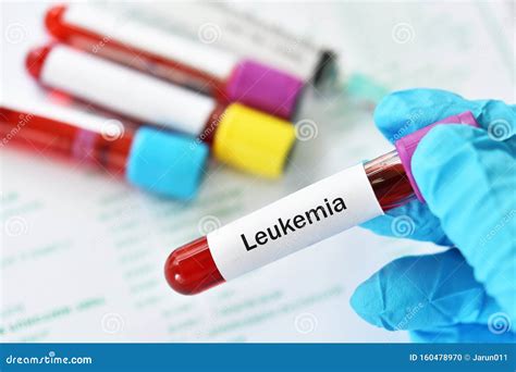 Blood For Leukemia Cells Test Stock Photo Image Of Acute