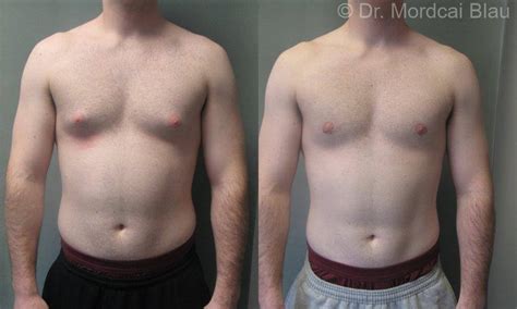 Puffy Nipples Before And After Photos Gynecomastia USA