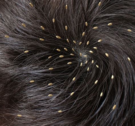 In addition, they need hair to help shield them from discovery and to continue with their daily activities uninterrupted. Treating Head Lice with Coconut Oil - Healthy Diet Base