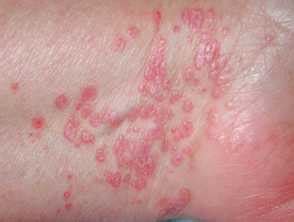 Lichen Planus Symptoms Types And Treatment With Images DermNet