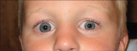 More than fifty different causes of glaucoma have been. Congenital Glaucoma: Types, Symptoms, Causes, Signs ...