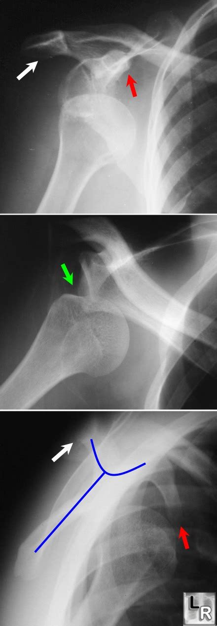 Learning Radiology Dislocation Shoulder Posterior Inferior