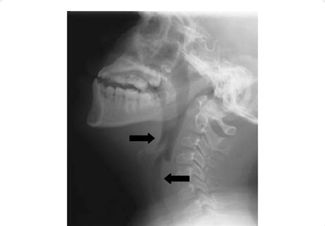 Lateral Radiograph Of The Neck In Patient With Croup Showing Subglottis