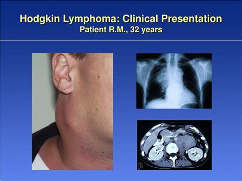 Ppt New Aspects In The Treatment Of Hodgkin Lymphoma Powerpoint