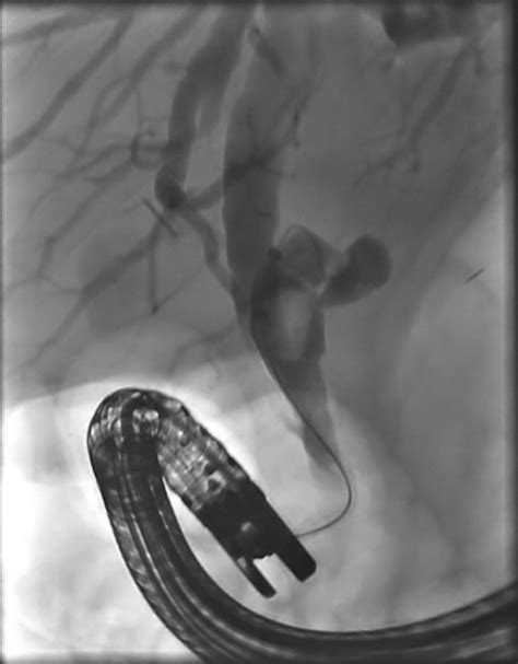 Large Cystic Filling Defect Seen On Cholangiogram From Initial Ercp