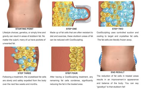 Sydney Coolsculpting Information On Body Contouring