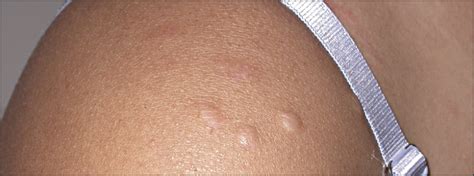 Atrophic Macules And Soft Papules In A 24 Year Old Woman—quiz Case