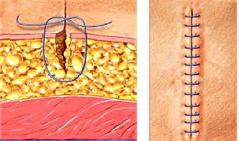 Suturas Descontinuas Aprenda O Passo A Passo Sutureskin
