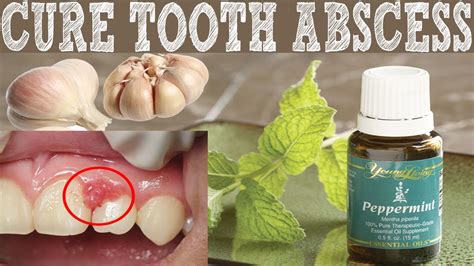 How To Cure Tooth Abscess Naturally Home Remedies To Cure Tooth