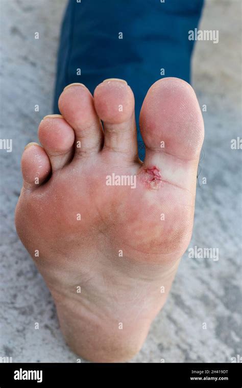 Fungal Foot Infection Hi Res Stock Photography And Images Alamy