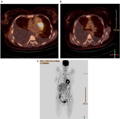 Frontiers Case Report And Review Of Literature Familial Malignant