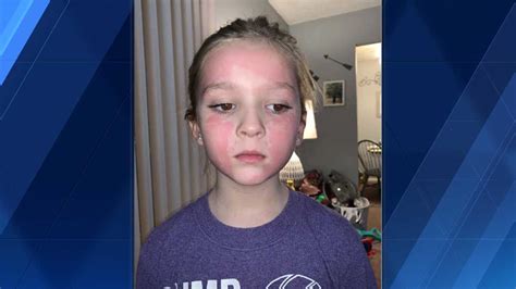 She Said It Burns Really Bad Omaha Mom Warns Others After Daughters