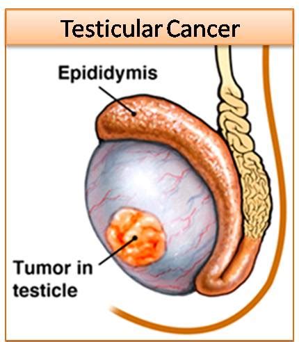 The most common testicular cancer symptom is a lump or a swelling in your testicle. Testicular Cancer: Symptoms, Treatment, Testicular Self ...