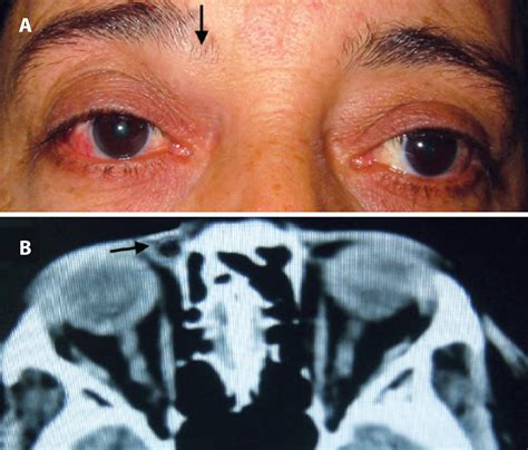 Scielo Brasil Extraconal Cystic Schwannoma Mimicking An Orbital