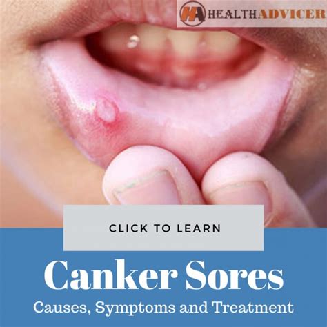 Canker Sores Causes Picture Symptoms And Treatment
