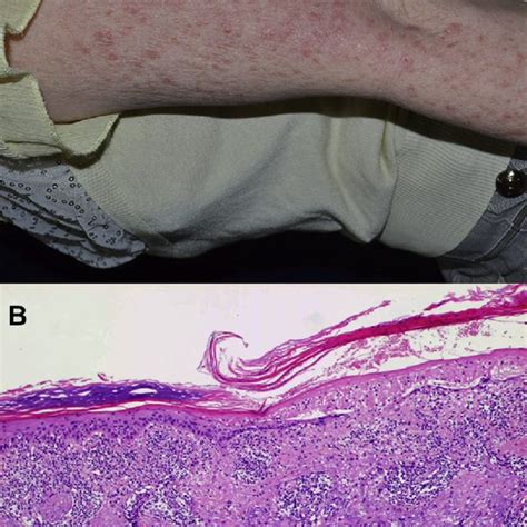 A Multiple Scaly Erythematous Maculopapules On Bilateral Upper Limbs
