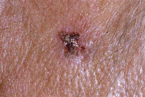 Skin Cancer Stock Image M1310563 Science Photo Library