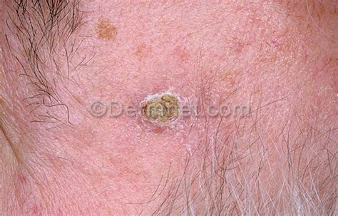 Squamous Cell Carcinoma Face Photo Skin Disease Pictures
