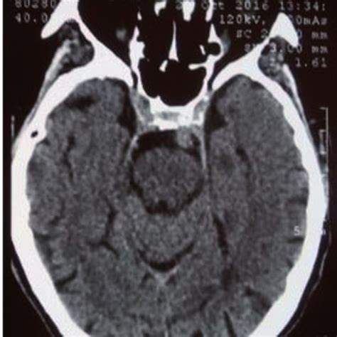 Ct Scan Performed For A Nasal Vault Concussion Without Fracture Of The