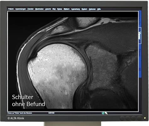 Mrt Schulter Diagnose Sehnenriss And Entzündung Schnell Erkennen Alta