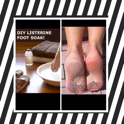 Diy Listerine Foot Soak Listerine Foot Soak Foot Soak Listerine