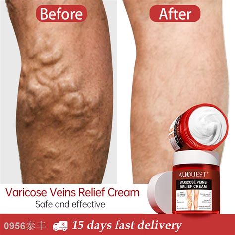 ♂varicose Veins Relief Cream Vasculitis Phlebitis Spider Pain Relief