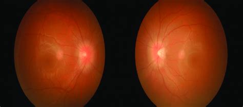 Fundus Examination Showed Resolution Of Bilateral Optic Disc Swelling