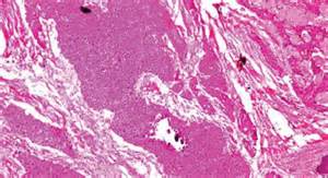 Pindborg Tumor Exhibiting Sheets Of Polyhedral Epithelial Cells With