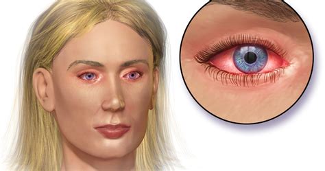 Apakah anda sedang mengalami mata merah? Cara Alami Mengatasi Mata Merah, Gatal & Berair | Tips & Cara