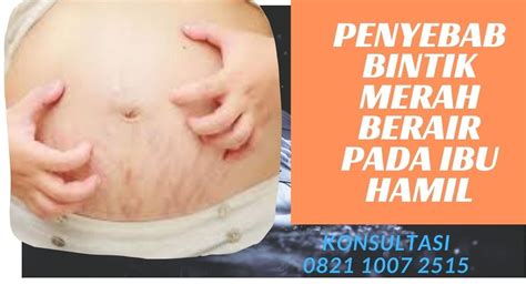 Kondisi ini umumnya tidak berbahaya dan dapat sembuh dengan sendirinya. Penyebab Bintik Merah Pada Ibu Hamil - YouTube