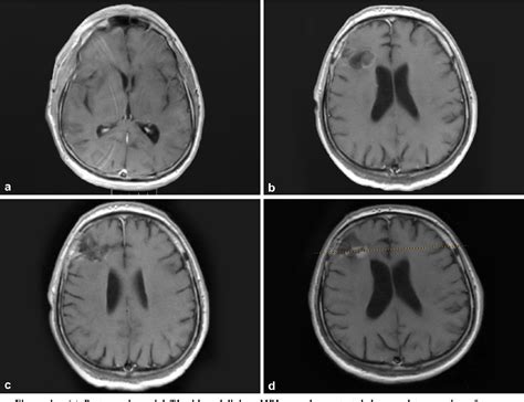 Figure 2 From Longer Survival Of A Patient With Glioblastoma Resected