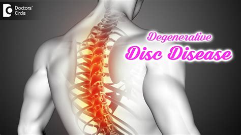 Degenerative Disc Disease Causes Symptoms Treatment Drkodlady