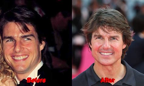 Has Tom Cruise Undergone Plastic Surgery
