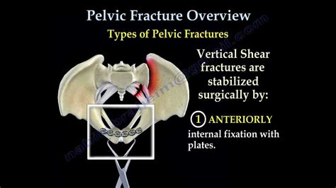 Pelvic Fracture Overview Everything You Need To Know Dr Nabil