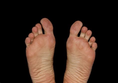 Can Oxygen Therapy Help Heal Diabetic Foot Ulcers