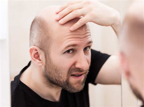 What Are The Factors That Contribute To Androgenetic Alopecia