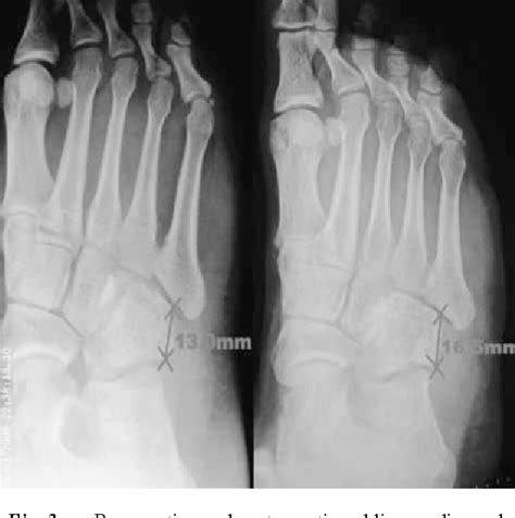 Figure 3 From Nutcracker Fracture Of The Cuboid Management And Results