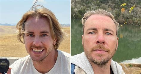Did Dax Shepard Get Plastic Surgery Experts Discuss His Fresh Look