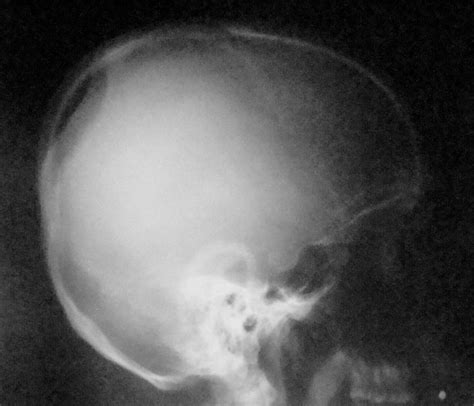 Plain Radiograph Of The Skull Depicting The Osteolytic Defect On The
