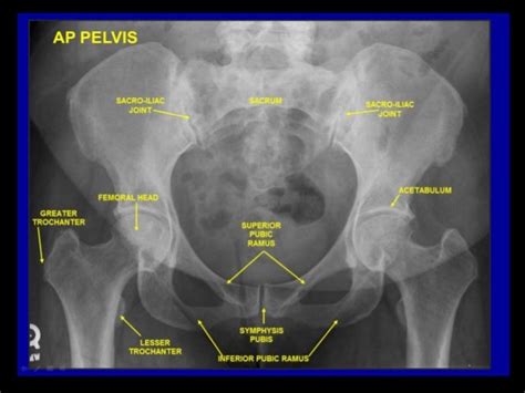 Pelvic Anatomy Xray Normal Pelvis Gender Differences Radiology