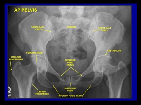 Radiographic anatomy of abd and pelvis r a