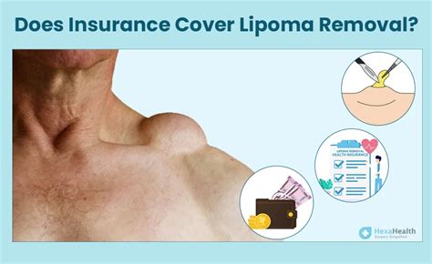 Is Lipoma Removal Surgery Covered By Insurance In India