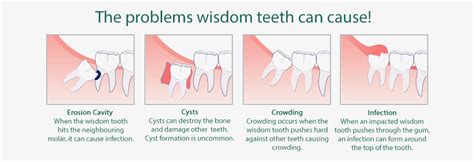 Everything You Need To Know About Wisdom Teeth Lara Village Dental