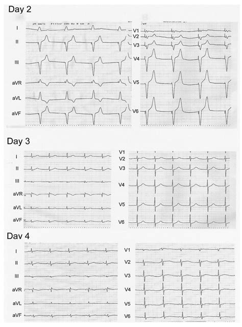 Ecg Done Daily After Angioplasty Ecg On Day Two Revealed A Pacing