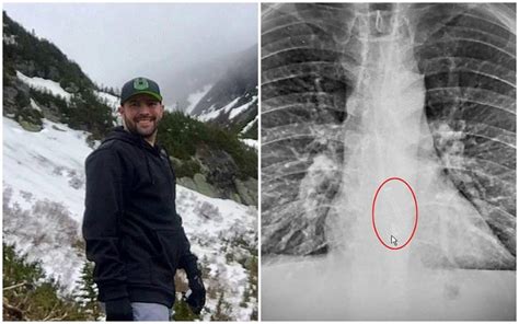 Man S X Ray Reveals He Accidentally Swallowed His AirPod While Sleeping Hollywood Unlocked