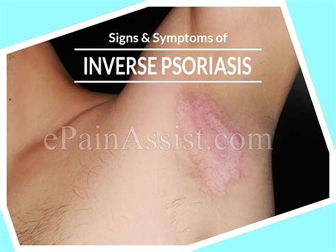 Recognizing The Signs And Symptoms Of Inverse Psoriasis Or Jock Itch