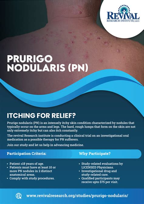 Prurigo Nodularis Clinical Trials
