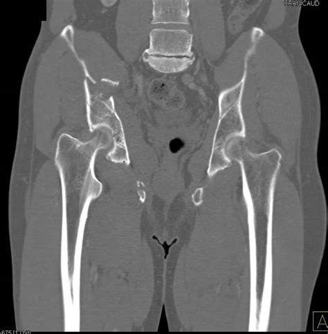 Acetabular Fractures with Pelvic Hematoma but Normal CT ...