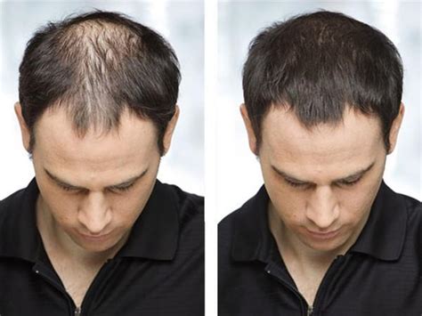 If you have sensitive skin, you can also use the product. What is Hair Loss Concealer and How to Benefit from It ...