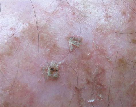 Keratosis Skin Cancer On Face